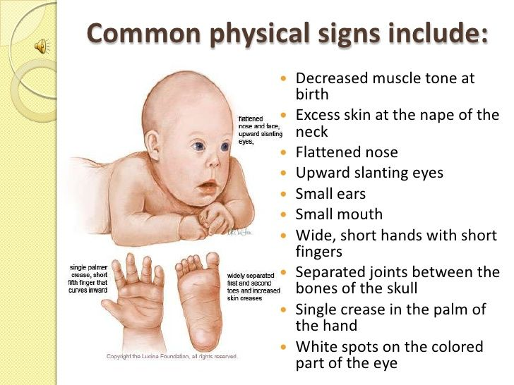 down-syndrome-causes-symptoms-diagnosis-and-treatment